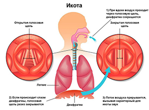 Как возникает икота